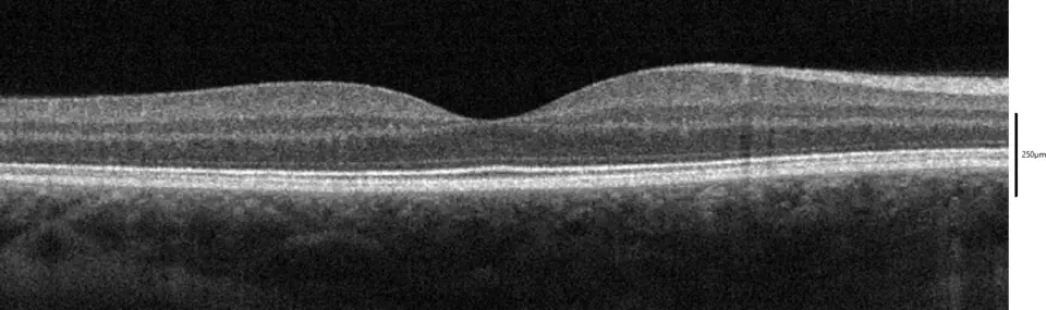 Retinal OCT macula cross-section