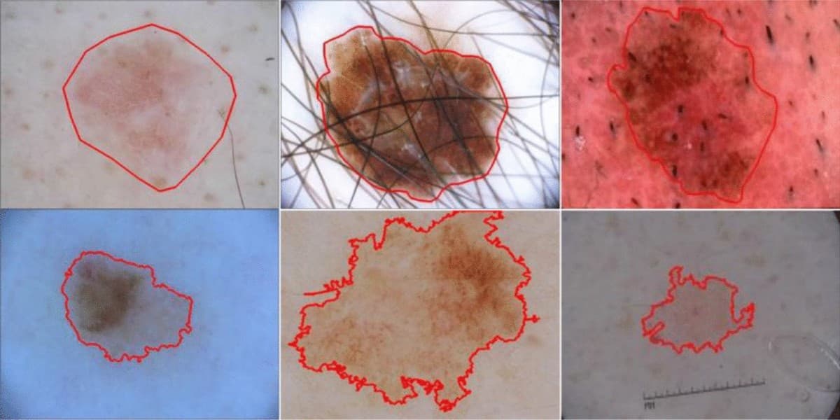 Dermatoscope view of a skin lesion