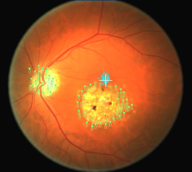 Fundus photograph of a human retina